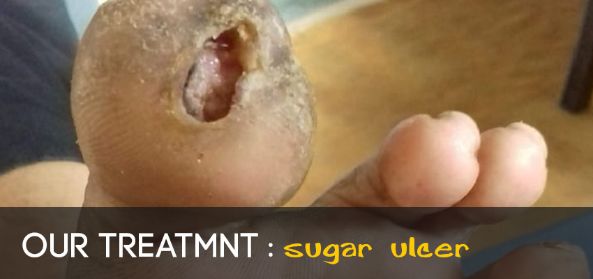 reflexology-treatment-sugar-ulcer